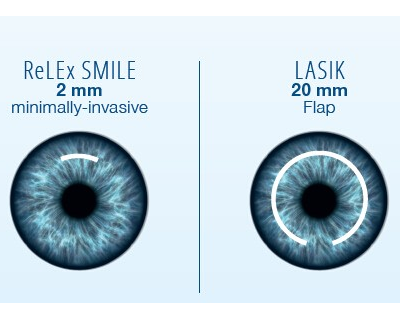 lasik_RELEX SMILE